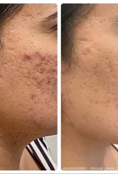 Revive Beauty Bar  Neo Elite® - Acne (23)