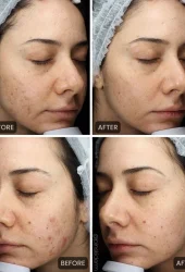 Neo Elite® - Acne (24)