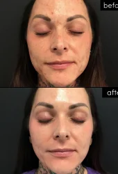 Neo Elite® - Acne (5)