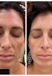 Revive Beauty Bar Aesthetics melasma treatment