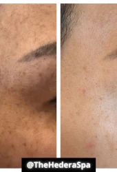Revive Beauty Bar Aesthetics melasma treatment