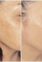 Revive Beauty Bar Aesthetics melasma treatment