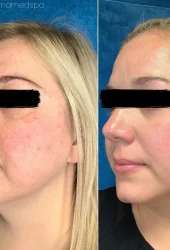 Neo Elite® - NeoSkin® - Skin Rejuvenation (3)