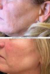 Neo Elite® - NeoSkin® - Skin Rejuvenation (4)