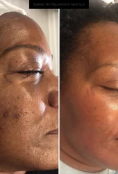 Neo Elite® - NeoSkin® - Skin Rejuvenation (SOC)