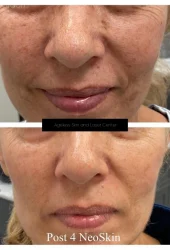 Neo Elite® - NeoSkin® - Skin Rejuvenation