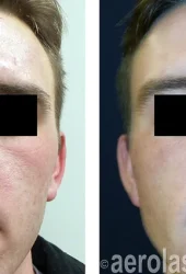Neo Rejuvenation - After 3 Treatments - Kevin Pinski MD
