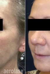 Neo Rejuvenation -Revive Beauty Bar Aesthetics