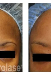 Revive Beauty Bar Aesthetics melasma treatment