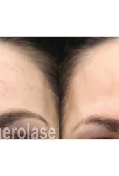 NeoSkin Melasma - After 1 Treatment combined with Salicylic Peel - Suneel Chilukuri MD