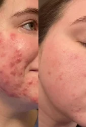 Revive Beauty Bar Aerolase Laser befor and after5