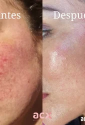Rosacea Treatments by Aerolase