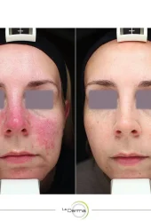 Rosácea por Aerolase (2)