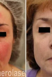 Rosacea2 - Pair