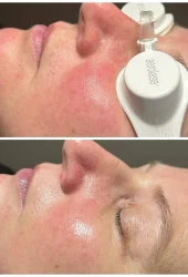 Rosásea por Aerolase