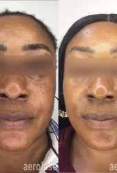 Revive Beauty Bar Aesthetics melasma treatment