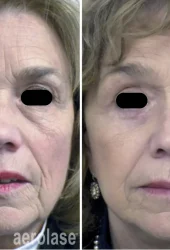 Skin Rejuvenation Revive Beauty Bar Aesthetics