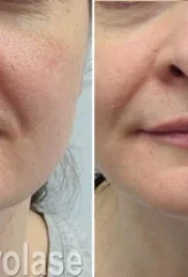 Skin Rejuvenation6 - Revive Beauty Bar Aesthetics