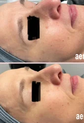 Skin Rejuventation by Aerolase