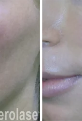 aerolase-neoskin-rosacea-kevin-pinski-after-1-treatment