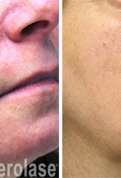 aerolase-rosacea-yelena-kipervas-1-treatment