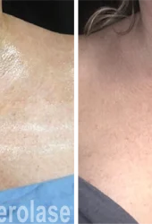 aerolase-skin-rejuvenation-after-4-treatments-jason-emer