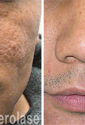 aerolase-skin-rejuvenation-fran cook bolden-after-7-treatments