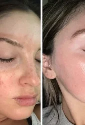 Revive Beauty Bar Aesthetics melasma treatment